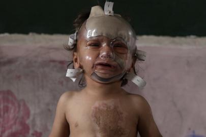 İsrail saldırılarında ağır yaralanan bebek tedavi bekliyor